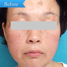 シミの症例(フォトプラス)の写真その1