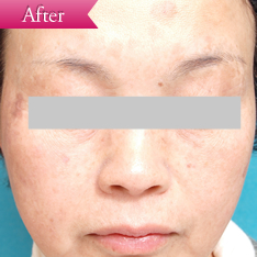 シミの症例(フォトプラス)の写真その3