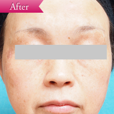 シミの症例(フォトプラス)の写真その4