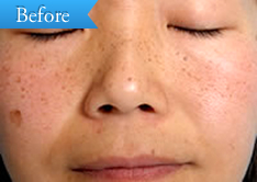 シミの症例(IPL)の写真その1