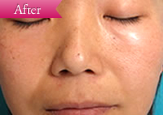 シミの症例(IPL)の写真その3