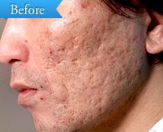 ニキビの症例(フランクショナルレーザー)の写真その1