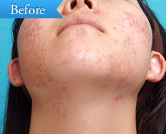 ニキビの症例(ケミカルピーリング)の写真その1