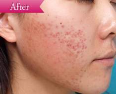 ニキビの症例(ケミカルピーリング)の写真その3