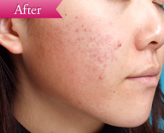 ニキビの症例(ケミカルピーリング)の写真その4