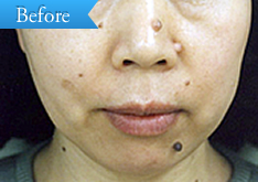 ほくろの症例(Co2レーザー)の写真その1