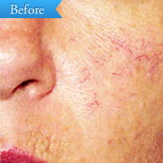 赤ら顔の症例(ロングパルスヤグレーザー)の写真その1