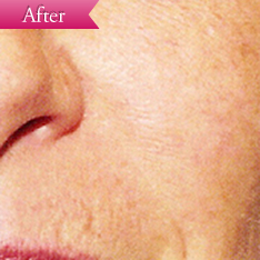 赤ら顔の症例(ロングパルスヤグレーザー)の写真その2