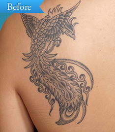 入れ墨の症例 (レーザー治療)の写真その1