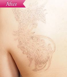 入れ墨の症例 (レーザー治療)の写真その4